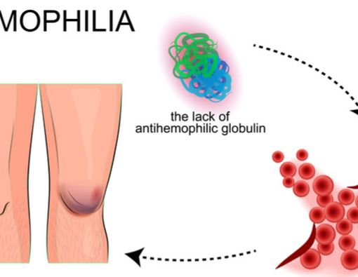 Mengenal Gejala Hemofilia