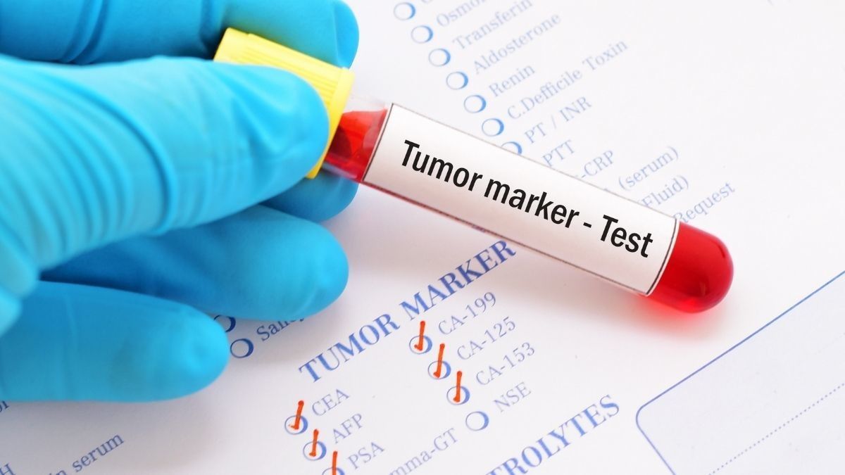 Mengenal Tumor Marker sebagai Metode Deteksi Kanker