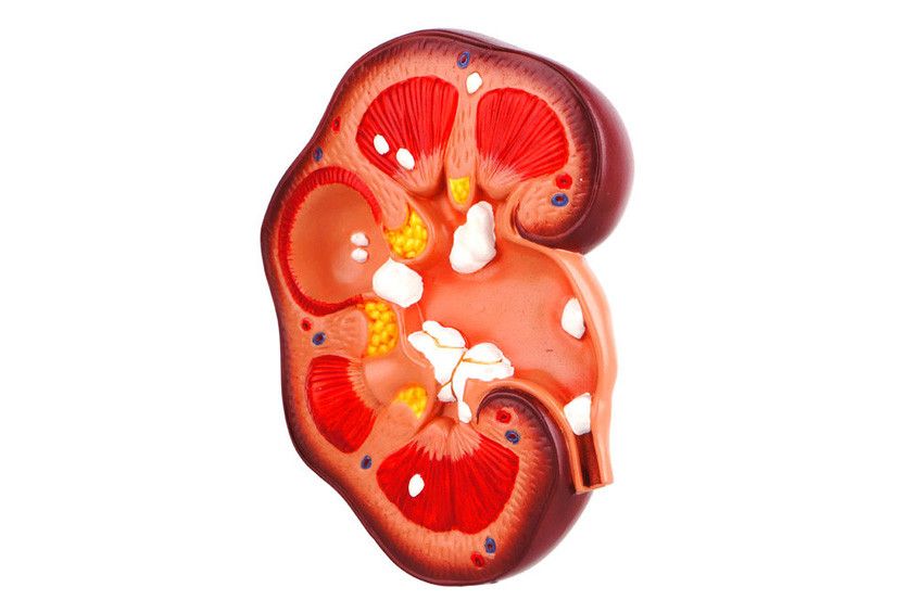 Benarkah Batu Ginjal Picu Infeksi Saluran Kemih?