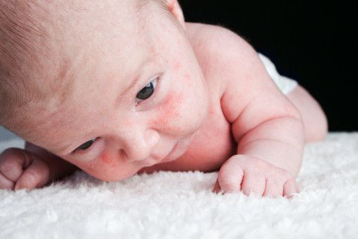  Prebiotik Cegah Kulit Gatal pada Bayi 