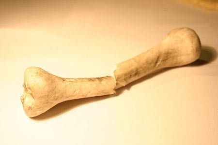Kunci Mencegah Patah Tulang pada Penyandang Osteoporosis 
