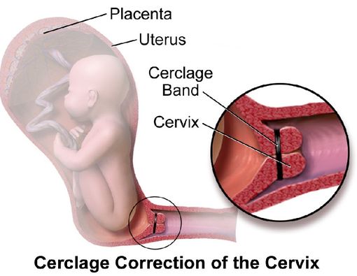 Mengenal Cervical Cerclage yang Dilakukan Pada Ibu Hamil