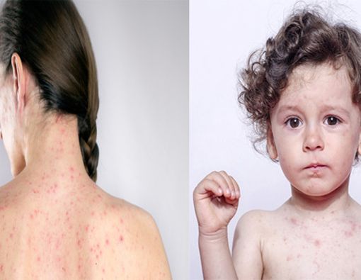 Apa Beda Campak pada Anak dan Orang Dewasa?