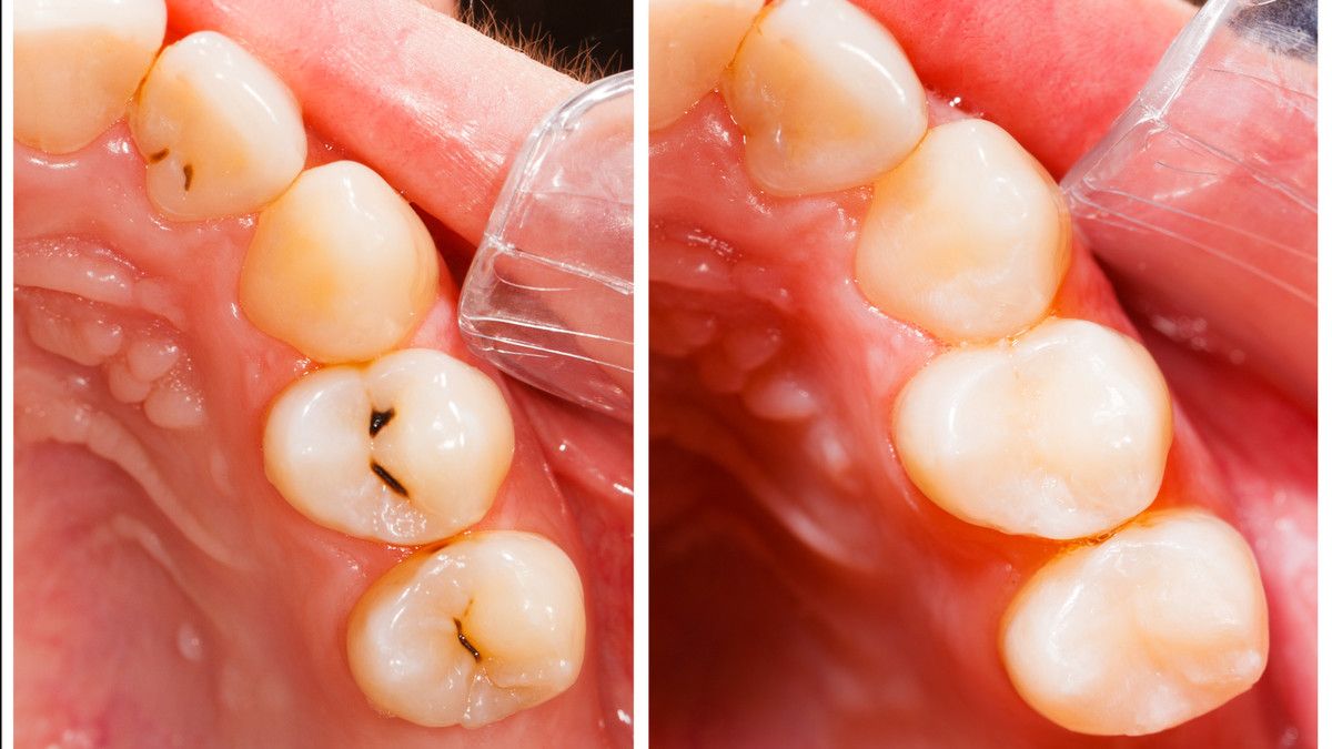 Bisakah Gigi yang Sudah Ditambal Berlubang Kembali?