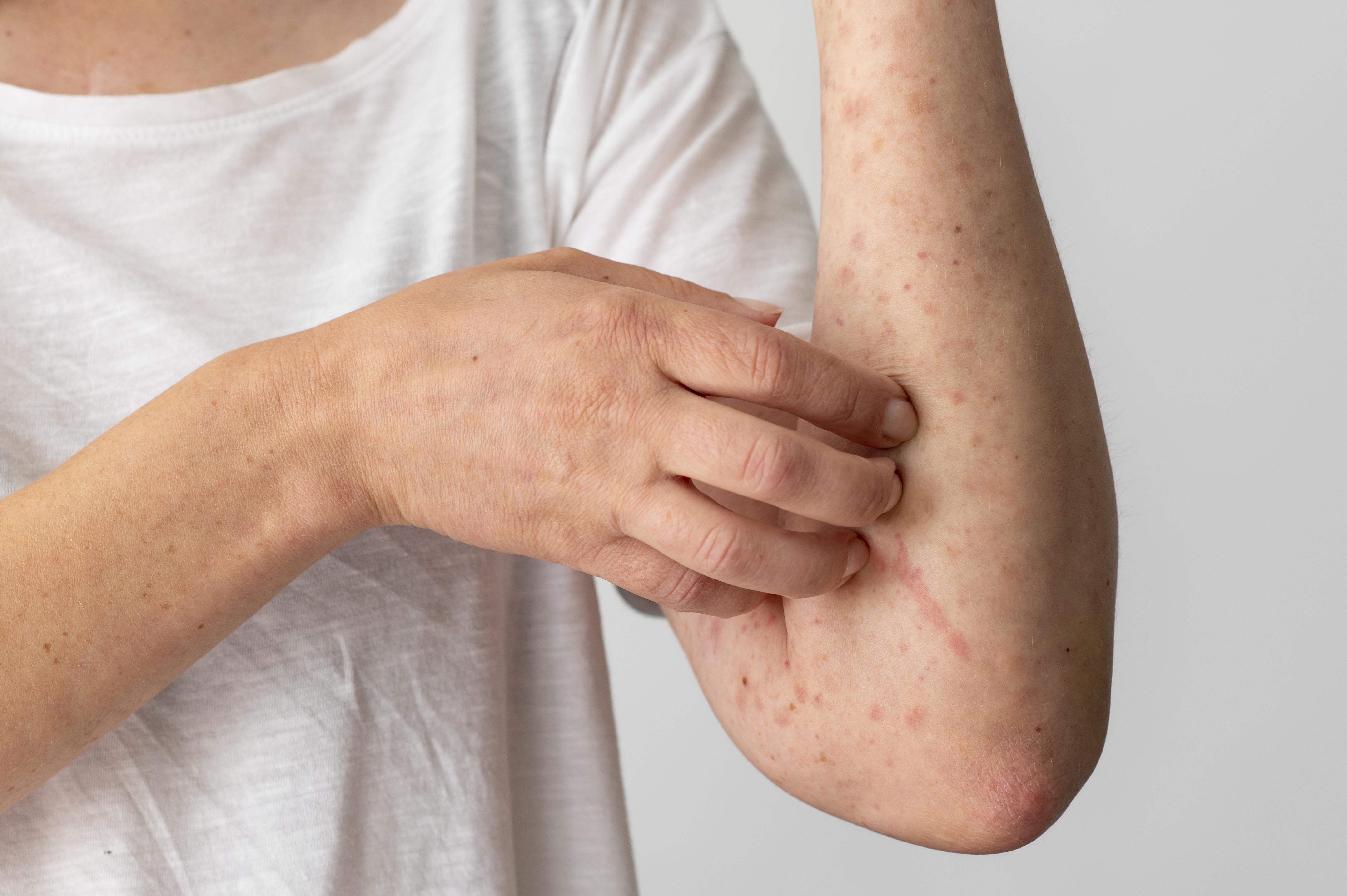 Dermatomiositis