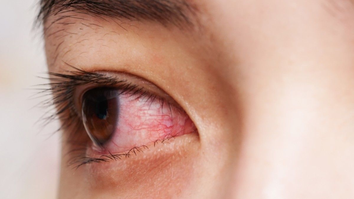 Gejala Virus Corona: Mata Merah Seperti Meradang