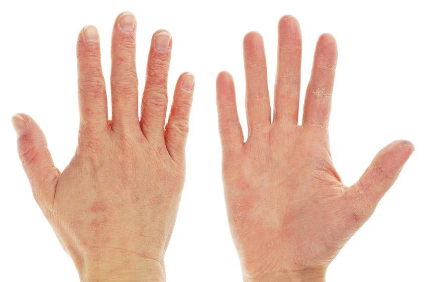 Osteoporosis dan Penyakit Eksim Berhubungan, Benarkah?