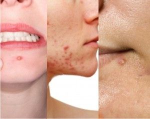 Kenali Jenis-Jenis Jerawat pada Kulit