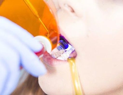 Cara Mencegah Munculnya Gigi Berlubang 