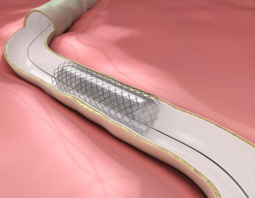 Yang Perlu Anda Tahu Soal Pemasangan Ring Jantung