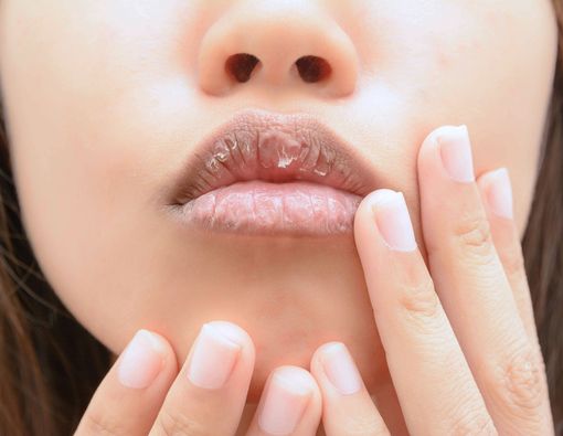 7 Penyebab Bibir Pecah-pecah