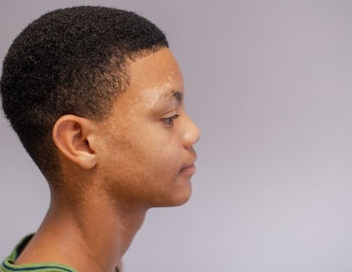 Panu Adalah Penyakit Keturunan, Mitos atau Fakta?