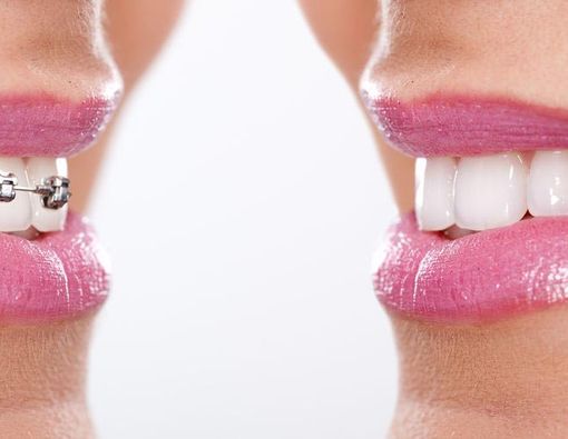 Haruskah Cabut Gigi Sebelum Pasang Behel?
