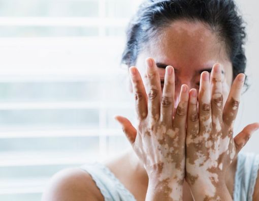 6 Penyebab Vitiligo, Bercak Putih di Kulit