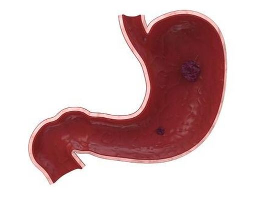 Mitos dan Fakta Tentang Ulkus Lambung