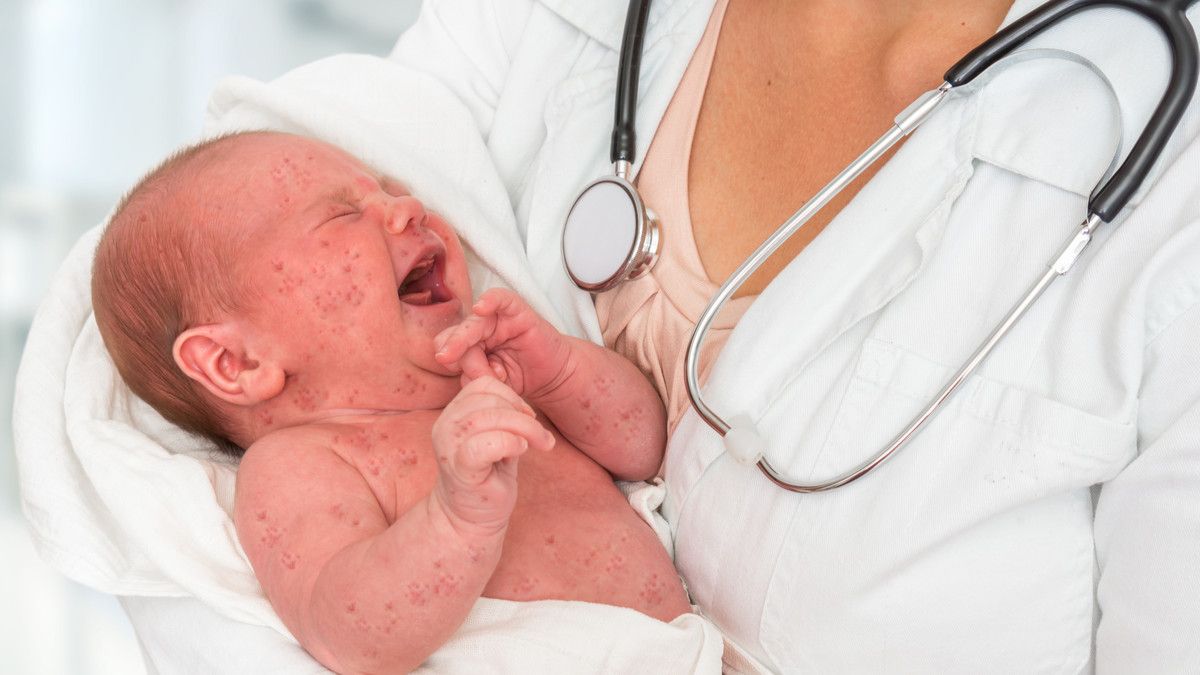 Mengenal Tanda-Tanda dan Gejala Herpes pada Bayi