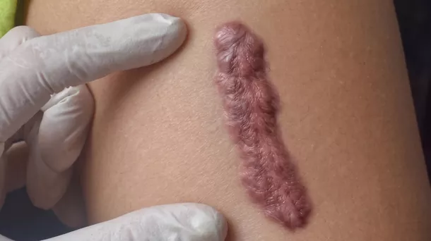 Cara Menghilangkan Keloid: Pilihan Perawatan yang Efektif