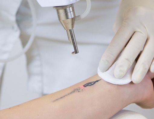 Ingin Menghilangkan Tato dengan Laser? Ketahui 7 Fakta Ini Dulu