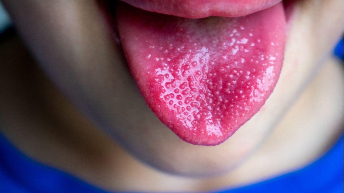 Lidah Stroberi, Gangguan Lidah yang Bisa Mengancam Nyawa