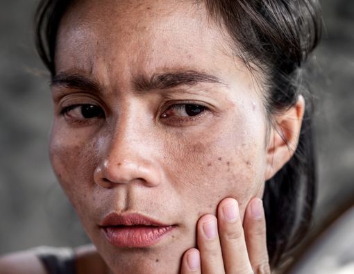 Mengapa Merkuri Pernah Jadi Bahan Skincare dan Bagaimana Cara Atasi Efek Sampingnya