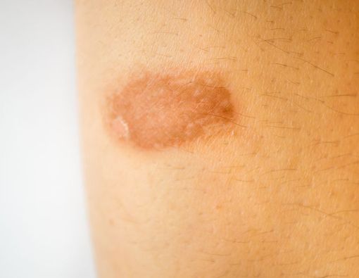 Cara Menghilangkan Luka Bakar Akibat Knalpot