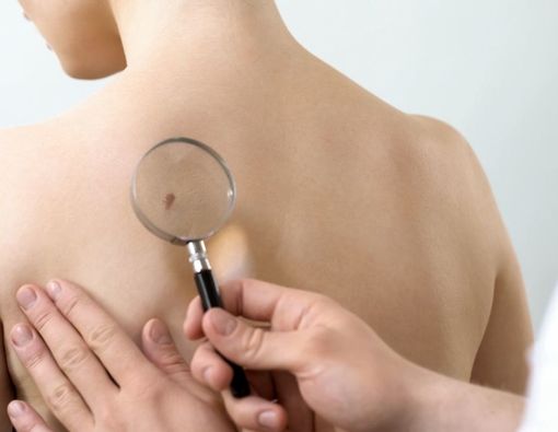 Kenali Mitos dan Fakta Seputar Kanker Kulit