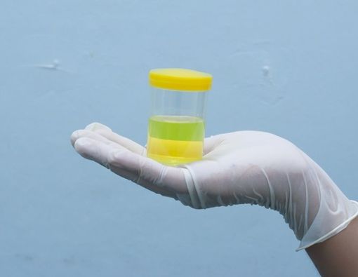 Mengenal Glikosuria, Kondisi Urine Mengandung Glukosa atau Gula Darah