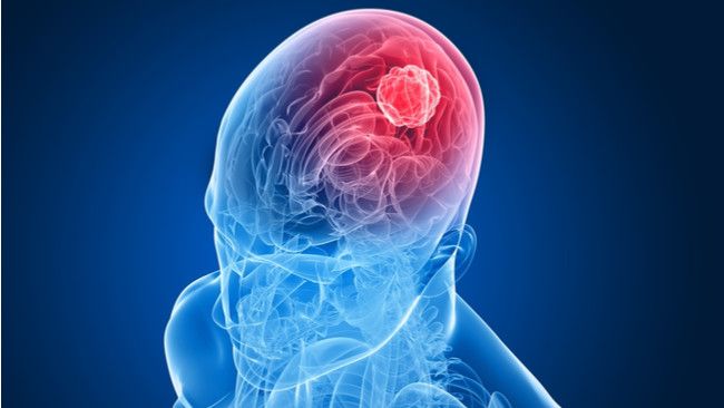 Benarkah Telinga Berdenging, Tanda Tumor Otak?