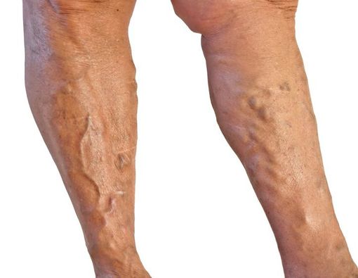 Overdosis Olahraga Bisa Sebabkan Varises?