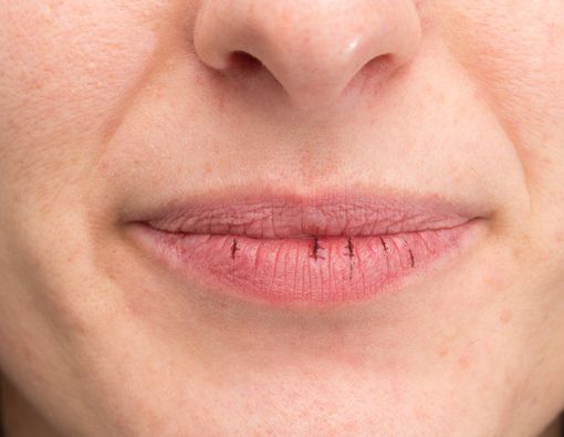 Luka di Bibir, Lakukan Ini untuk Mengatasinya