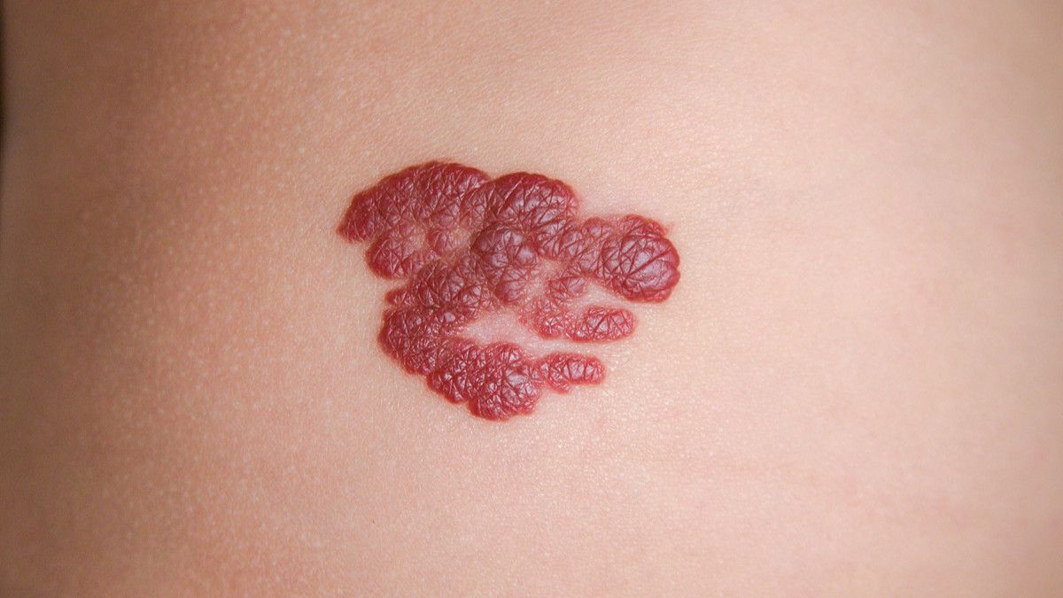 Hemangioma, Bisakah Disembuhkan?