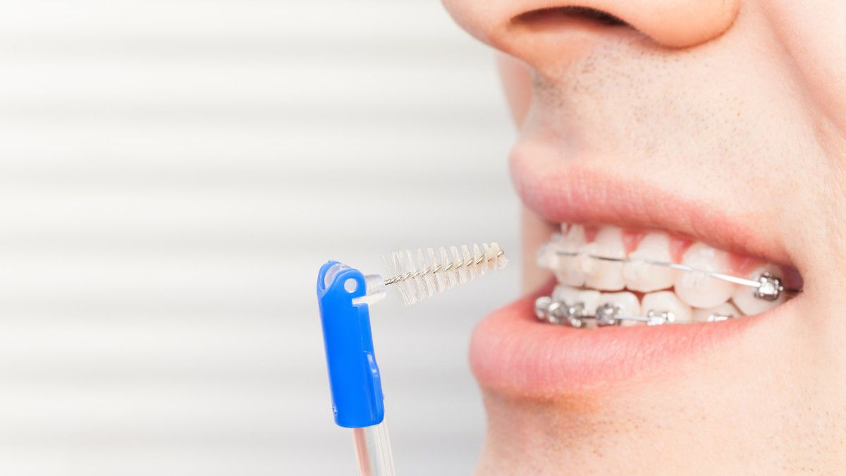 Untuk Pemula, Ini Tips Merawat Gigi dengan Behel