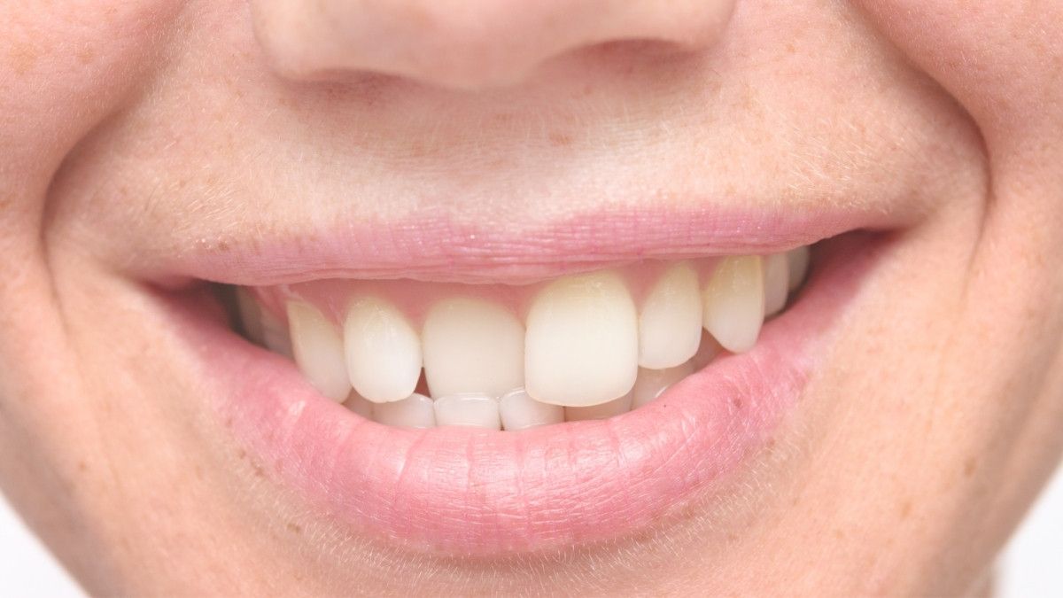Gigi Gingsul Bisa Picu Pengikisan Akar Gigi, Benarkah?