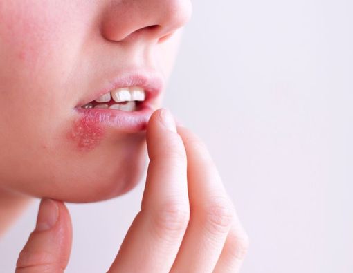 Perbedaan Gejala Jerawat dan Herpes Zoster