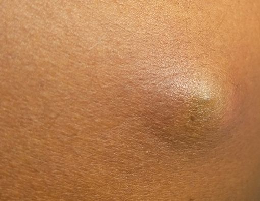 Cara Ampuh Mengobati Bisul yang Mengganggu