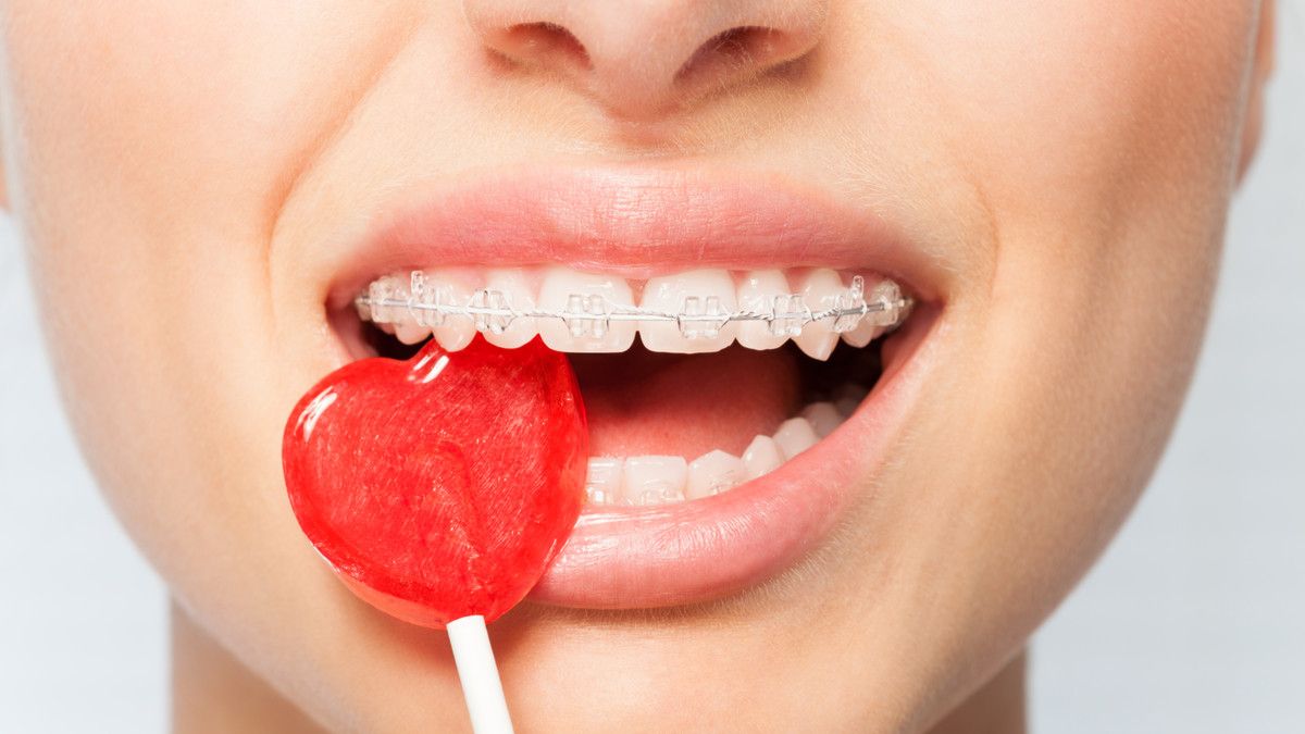 Makanan yang Harus Dihindari Saat Pakai Kawat Gigi