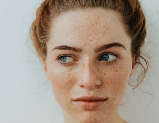 Fakta tentang Freckles yang Perlu Anda Ketahui