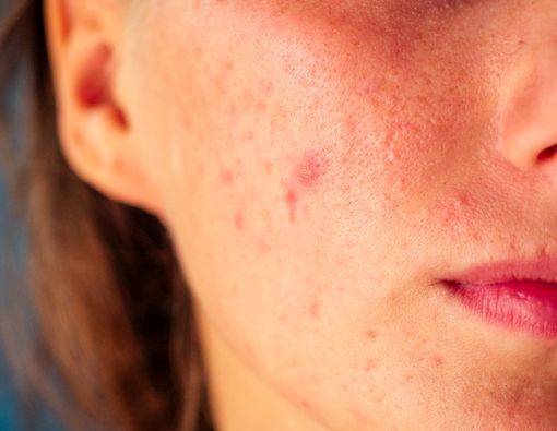 Milia, Gangguan Kulit Wajah yang Mirip Jerawat dan Beruntusan