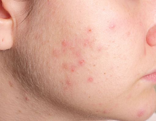 Salah Pilih Sabun, Ini Akibatnya!