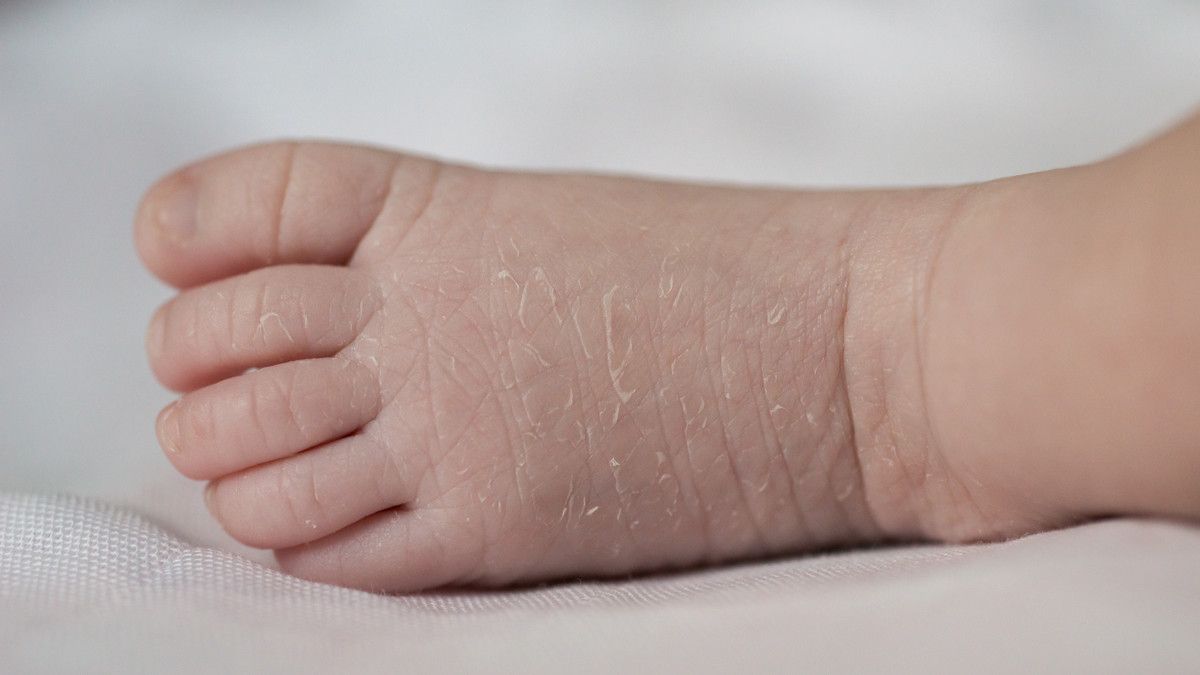 Bayi Gampang Sakit Kulit Akibat Terlalu Higienis?