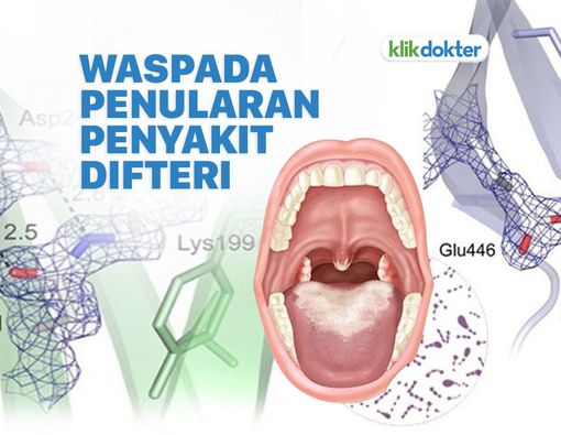 Waspada, Ini Cara Penularan Difteri