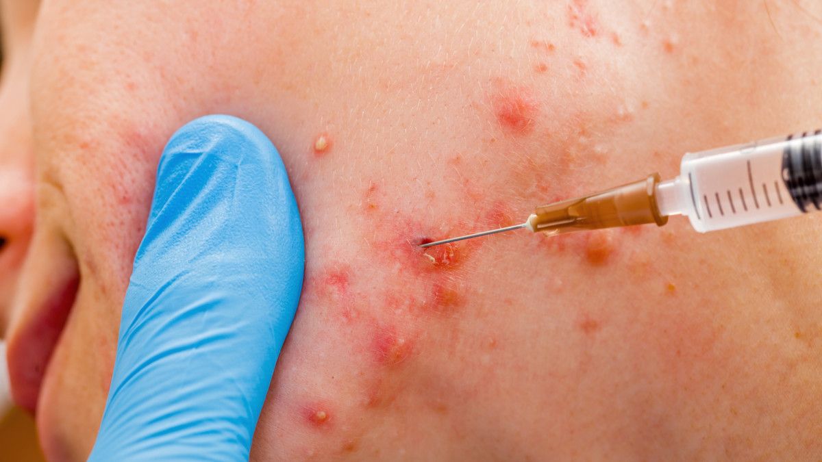 Suntik Jerawat, Amankah untuk Dilakukan?
