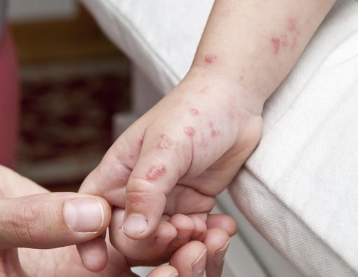 Kulit si Kecil seperti Disundut Rokok? Hati-hati, Cacar Api!