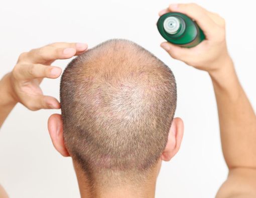 Benarkah Obat Penumbuh Rambut Picu Disfungsi Ereksi?