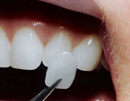 Senyum Menawan dengan Veneers