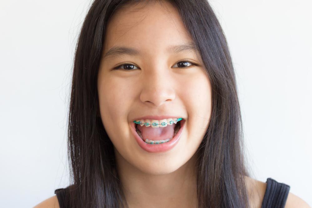 Usia Berapa Anak Boleh Memakai Kawat Gigi?