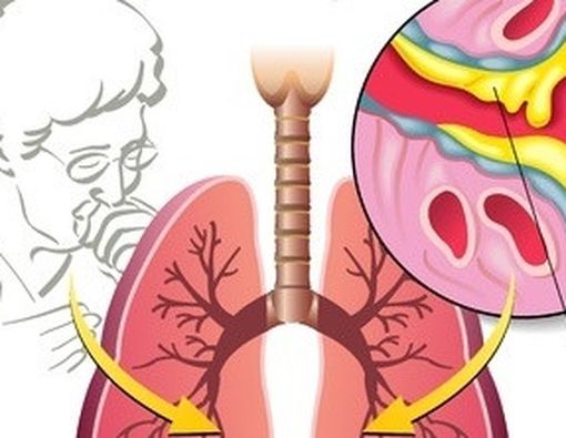 Arti Warna pada Lendir Hidung