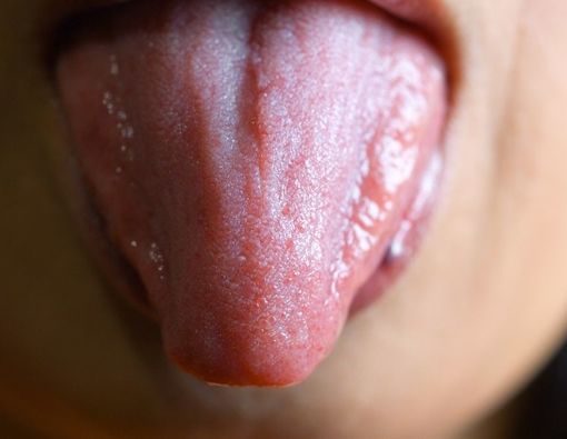 Perawatan Rumahan untuk Langit Mulut yang Terbakar