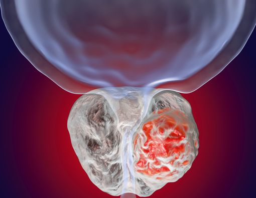 Bahaya Kanker Prostat yang Harus Anda Tahu