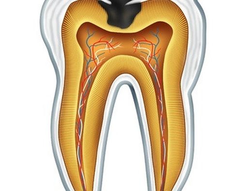 4 Cara Jitu Bebas Gigi Berlubang
